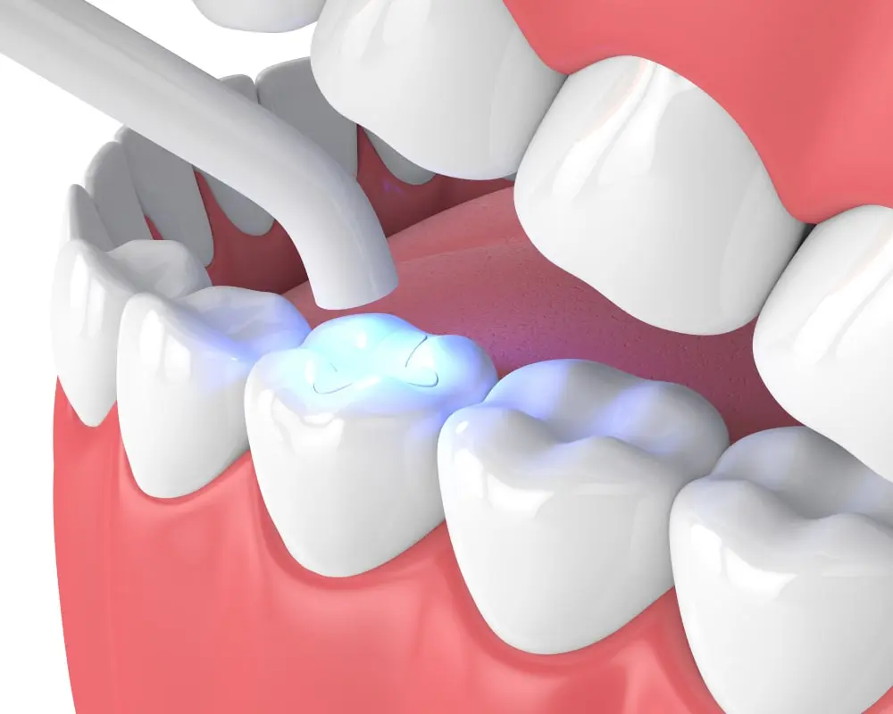 Soins conservateurs caries dévitalisation Casablanca
