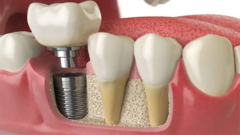 Implants dentaires Casablanca